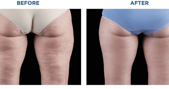 Choosing Between Emtone vs Emsculpt Neo: Which Is Right for You - Northvilla Beauty Spa