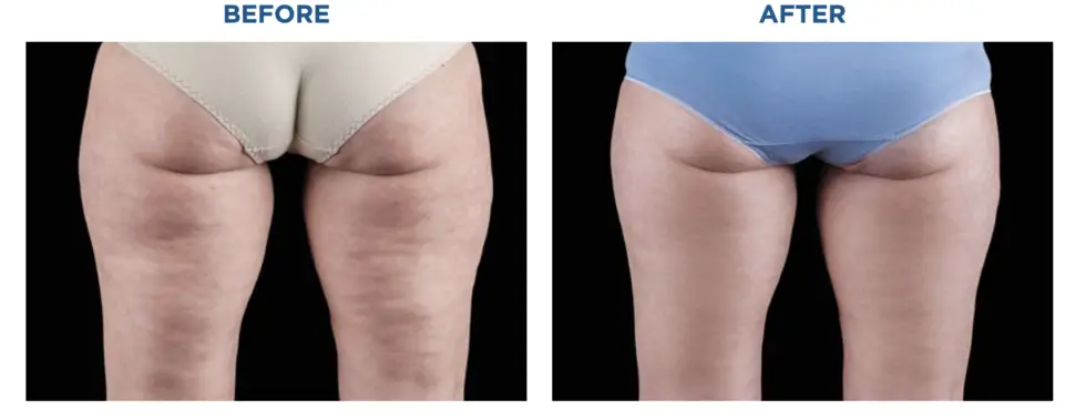 Choosing Between Emtone vs Emsculpt Neo: Which Is Right for You - Northvilla Beauty Spa