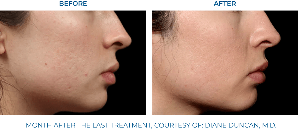 EXION RF Microneedling - Northvilla Beauty Spa