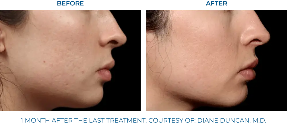 EXION RF Microneedling - Northvilla Beauty Spa
