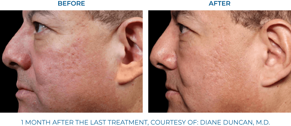 EXION RF Microneedling - Northvilla Beauty Spa