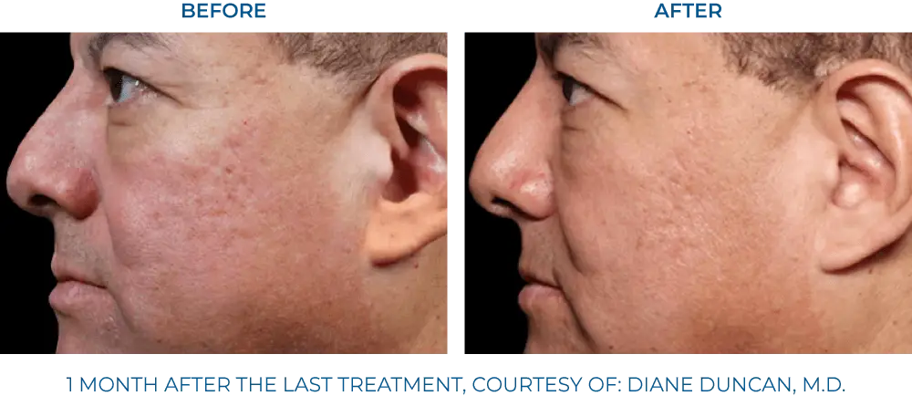 EXION RF Microneedling - Northvilla Beauty Spa