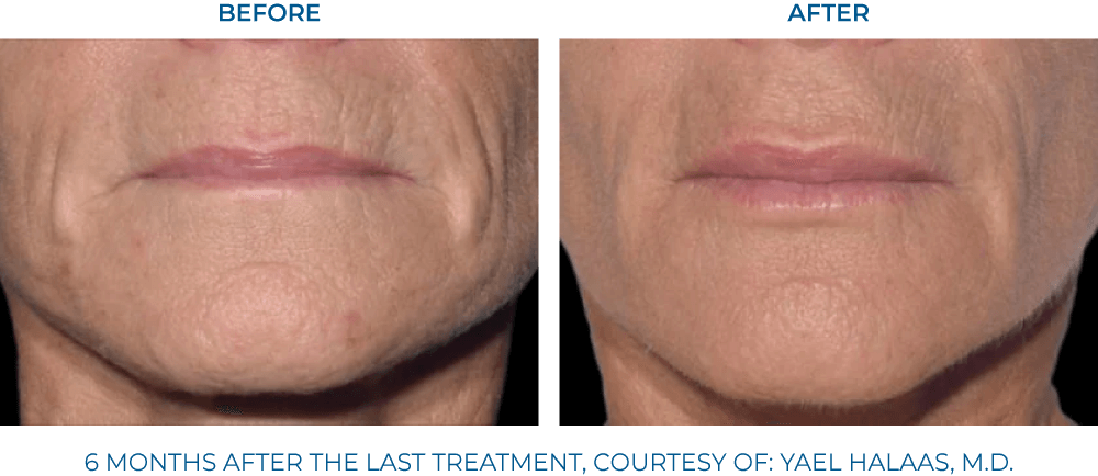 EXION RF Microneedling - Northvilla Beauty Spa