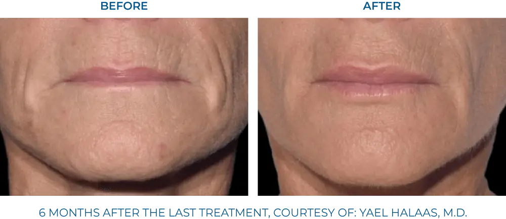 EXION RF Microneedling - Northvilla Beauty Spa