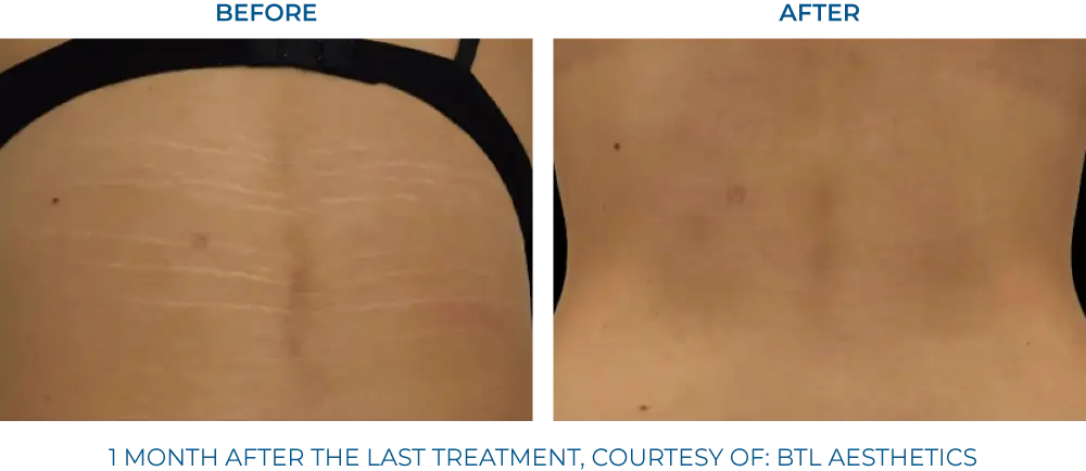EXION RF Microneedling - Northvilla Beauty Spa