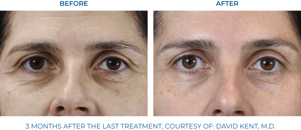 EXION RF Microneedling - Northvilla Beauty Spa