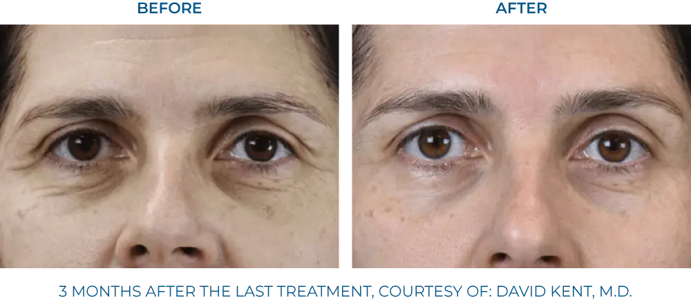EXION RF Microneedling - Northvilla Beauty Spa