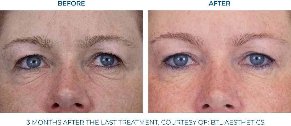 EXION RF Microneedling - Northvilla Beauty Spa