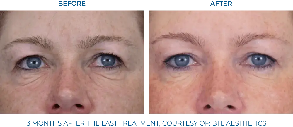 EXION RF Microneedling - Northvilla Beauty Spa