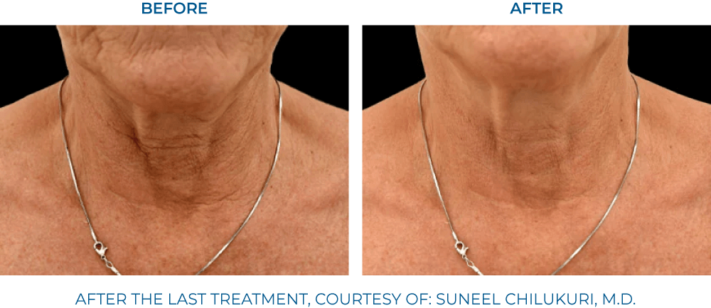 EXION RF Microneedling - Northvilla Beauty Spa