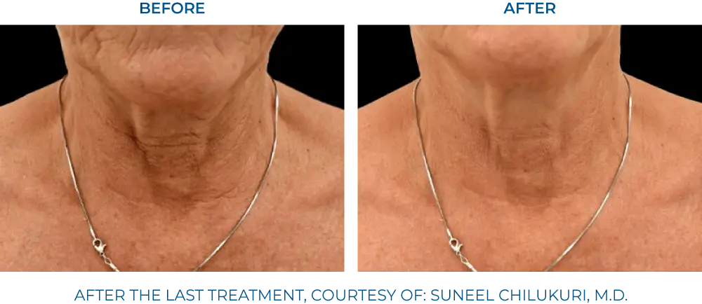 EXION RF Microneedling - Northvilla Beauty Spa
