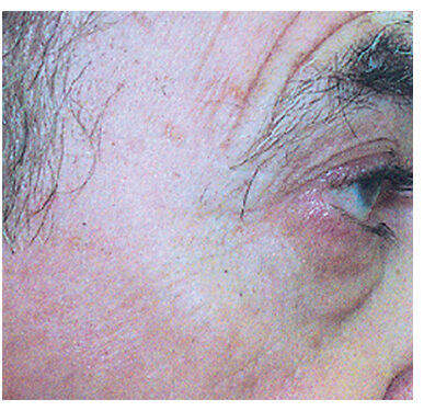 Laser Hair Removal - Northvilla Beauty Spa