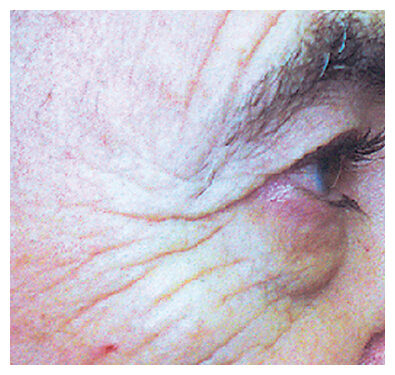 Laser Hair Removal - Northvilla Beauty Spa