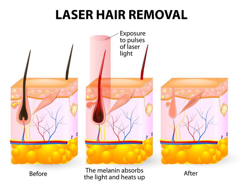 Laser Hair Removal - Northvilla Beauty Spa