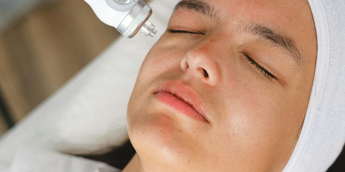 Close-up of a woman receiving CO2 laser treatment
