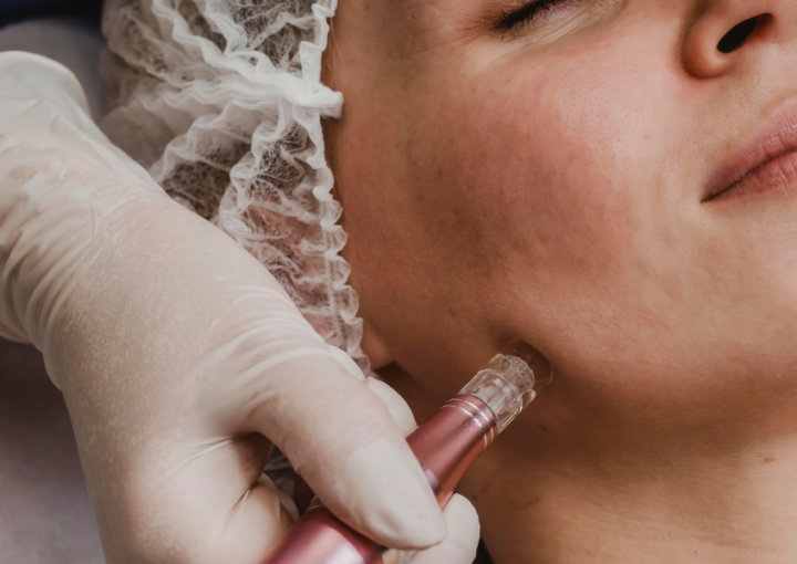 CO₂ Laser vs Microneedling: Comparing Results, Cost, and Recovery - Northvilla Beauty Spa