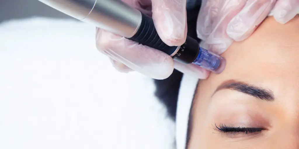Your Step by Step EXION RF Microneedling Results Timeline - Northvilla Beauty Spa