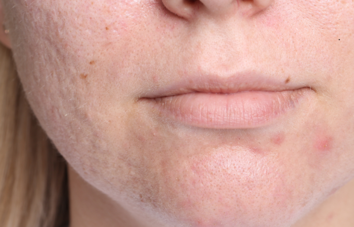 How EXION RF Microneedling Helps Reduce Acne Scars and Stretch Marks - Northvilla Beauty Spa