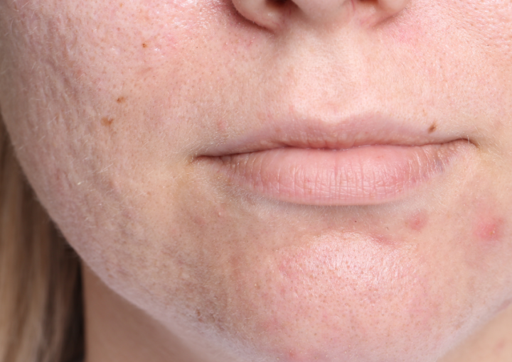 How EXION RF Microneedling Helps Reduce Acne Scars and Stretch Marks - Northvilla Beauty Spa