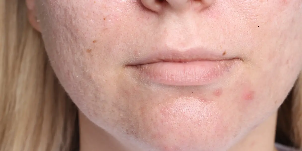 How EXION RF Microneedling Helps Reduce Acne Scars and Stretch Marks - Northvilla Beauty Spa