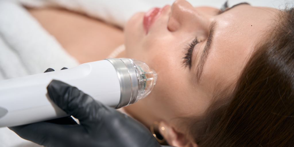 How EXION RF Microneedling Helps Reduce Acne Scars and Stretch Marks - Northvilla Beauty Spa