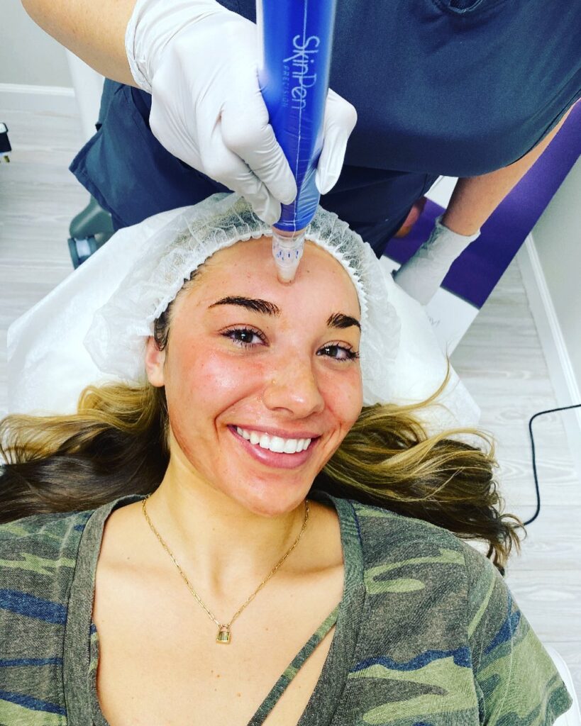 Microneedling Showdown: SkinPen vs EXION RF Microneedling – Which Is Right For You? - Northvilla Beauty Spa