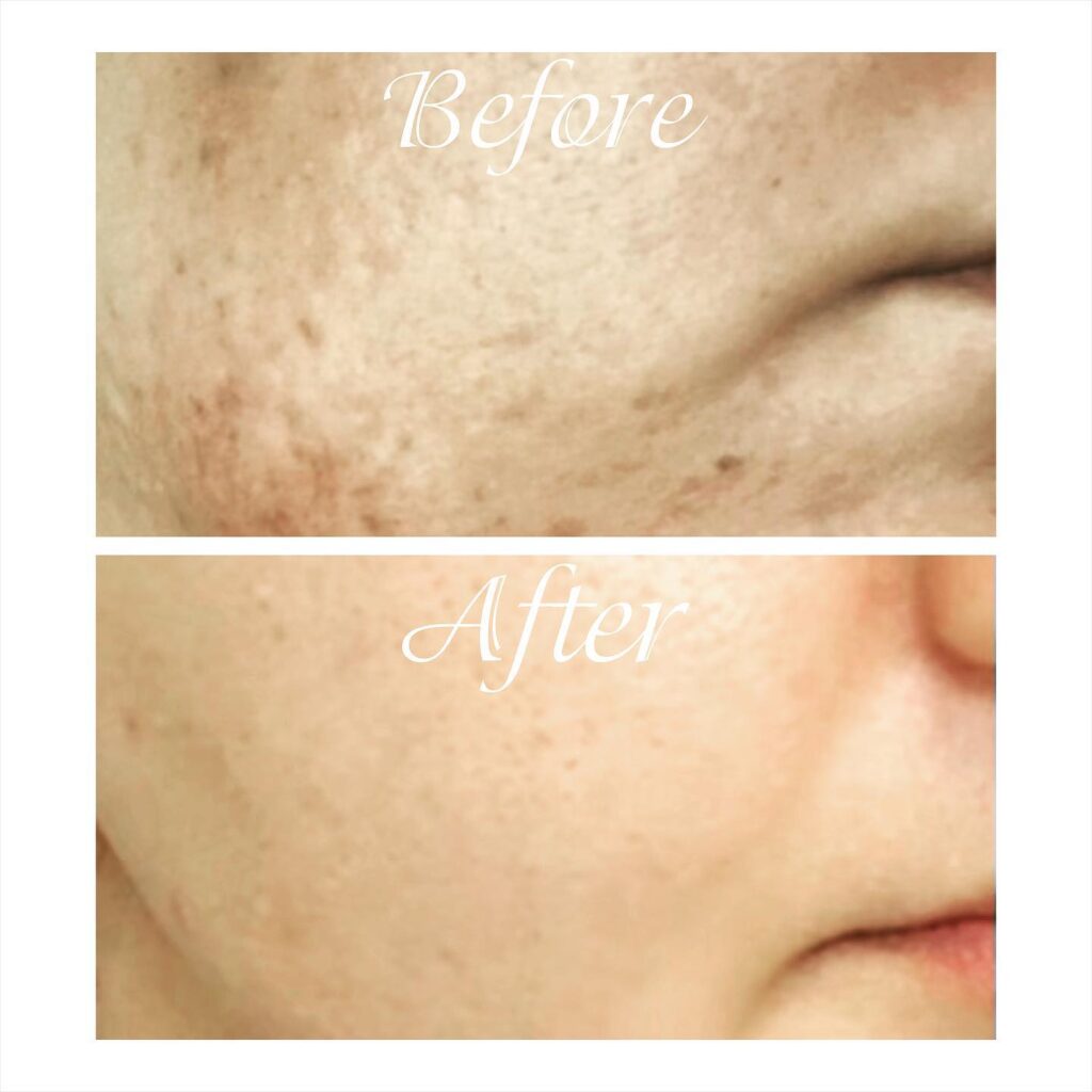 Microneedling Showdown: SkinPen vs EXION RF Microneedling – Which Is Right For You? - Northvilla Beauty Spa