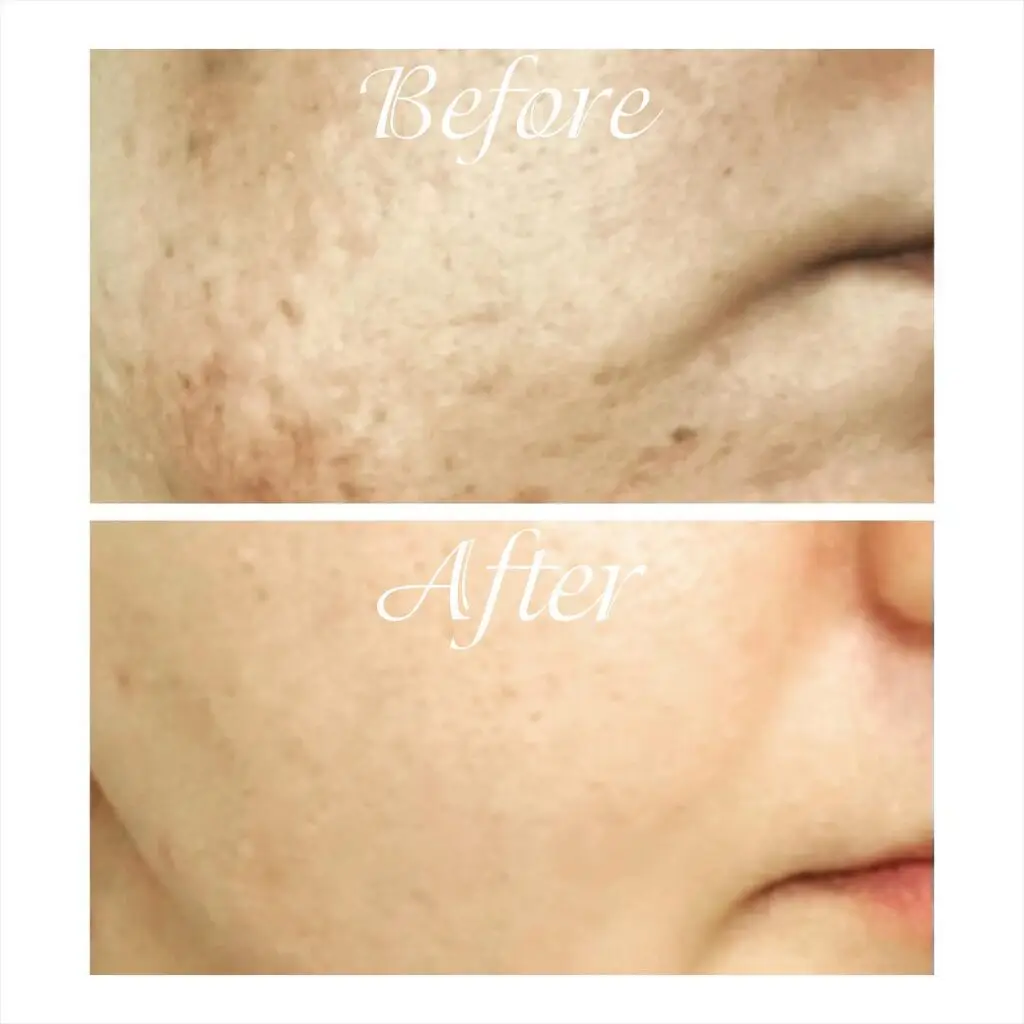 Microneedling Showdown: SkinPen vs EXION RF Microneedling – Which Is Right For You? - Northvilla Beauty Spa