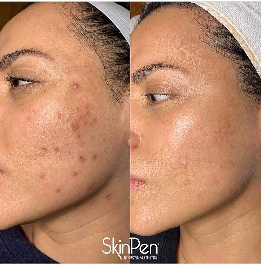 Microneedling Showdown: SkinPen vs EXION RF Microneedling – Which Is Right For You? - Northvilla Beauty Spa