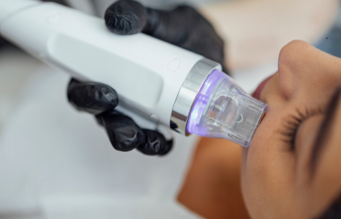 Microneedling Showdown: SkinPen vs EXION RF Microneedling – Which Is Right For You? - Northvilla Beauty Spa
