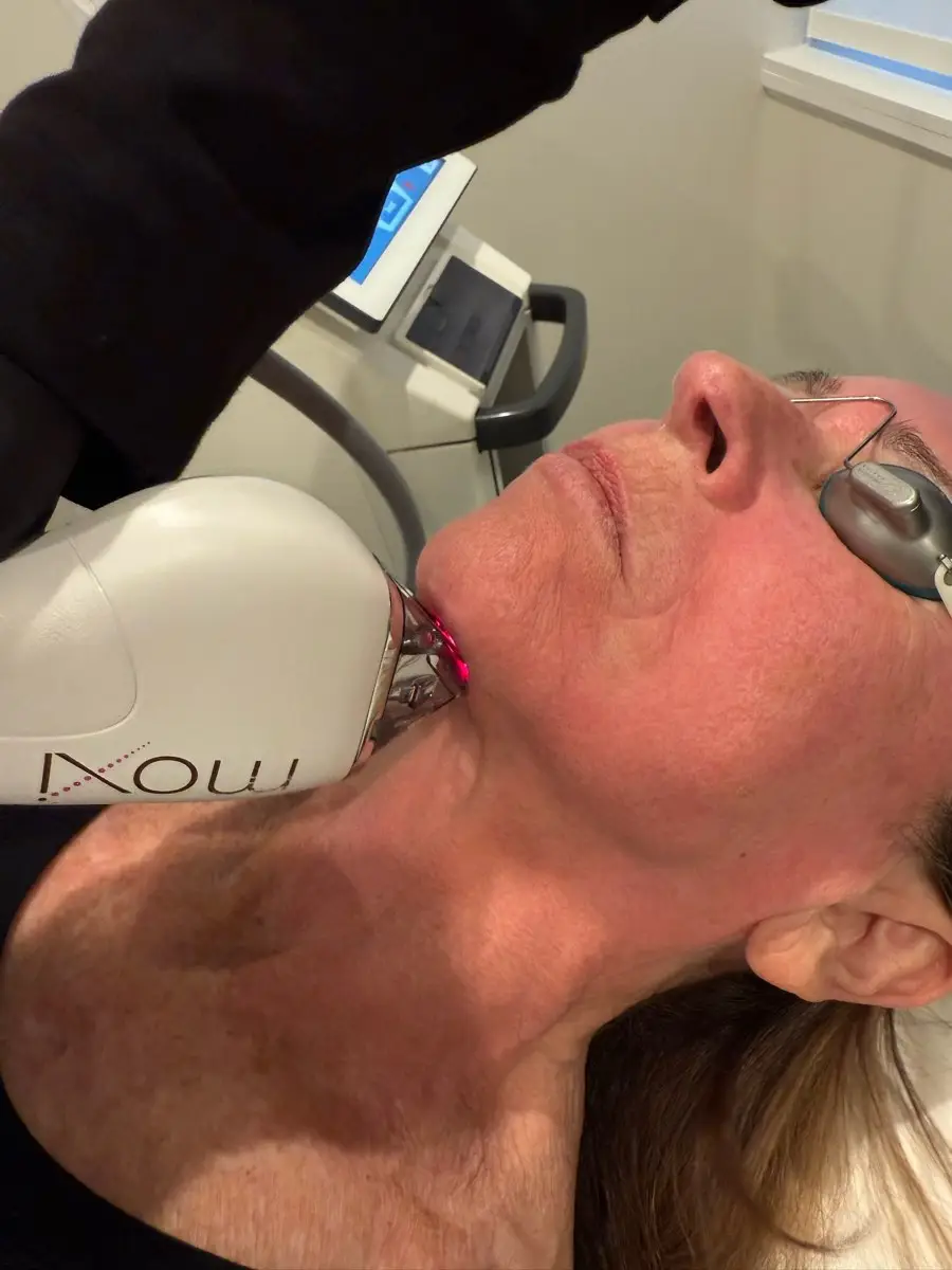 MOXI Laser Resurfacing - Northvilla Beauty Spa