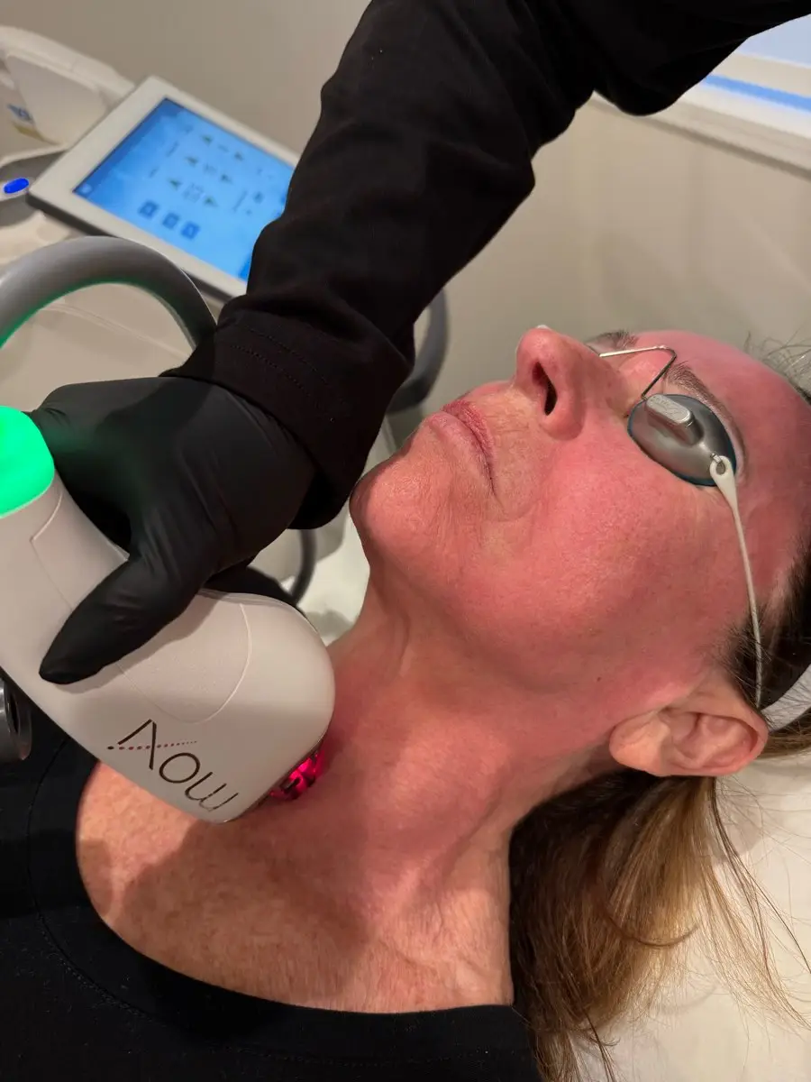 MOXI Laser Resurfacing - Northvilla MI